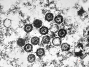 M,10y. | herpes virus - herpetic encephalitis